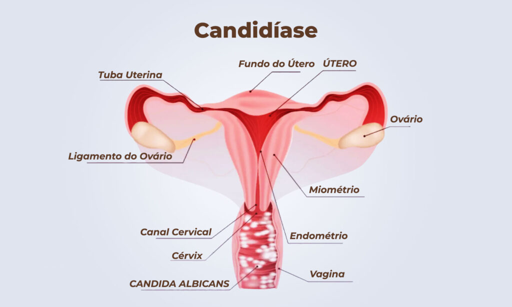 O que é candidíase