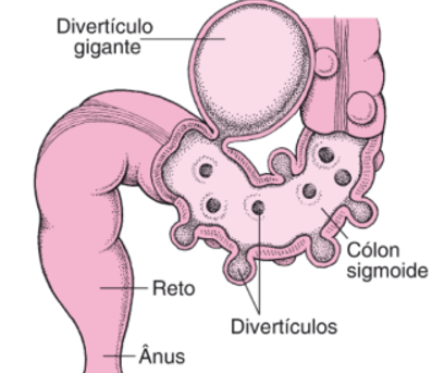 Diverticulite e diverticulose: O que é?