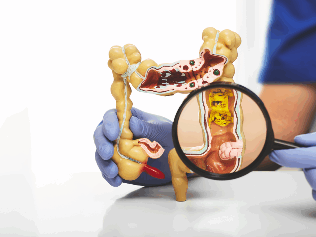 Qual a diferença entre diverticulite e diverticulose?